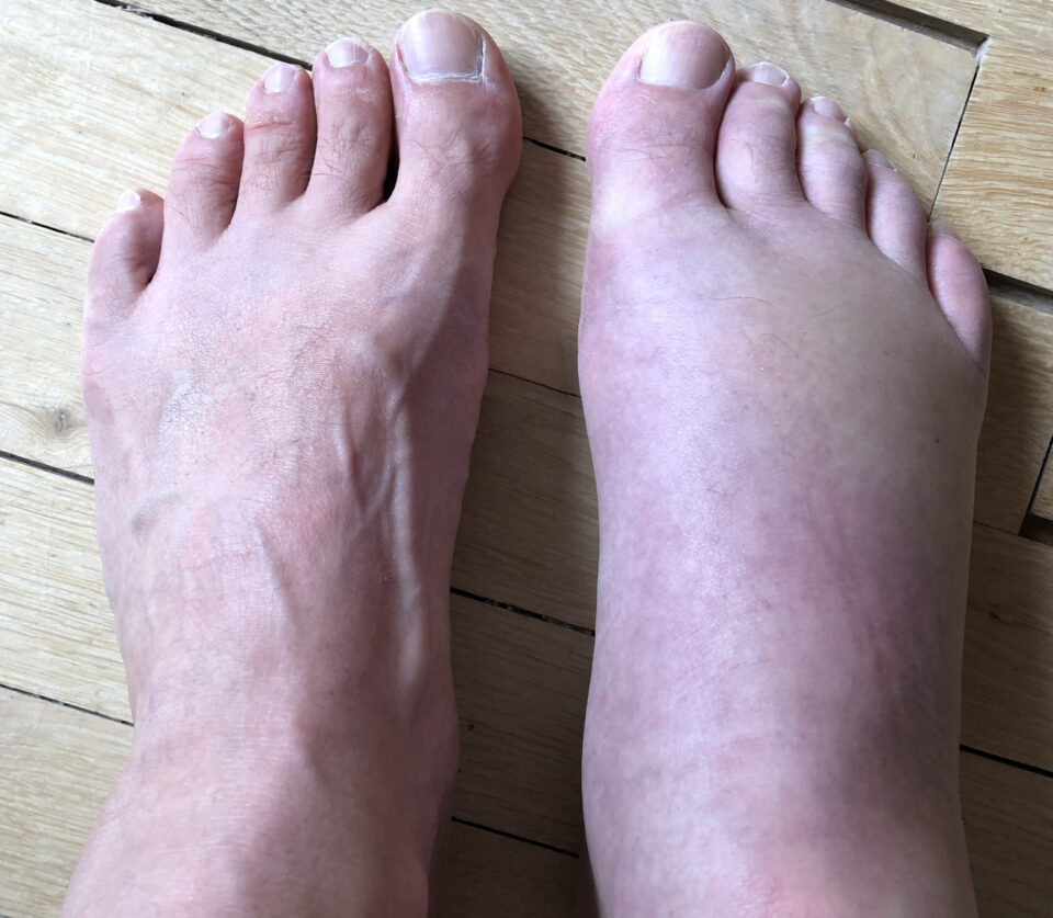 Algodystrophie du pied