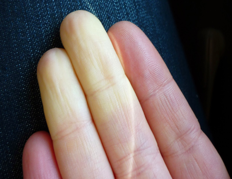 maladie de Raynaud