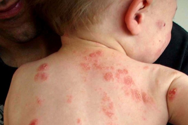 l’eczema